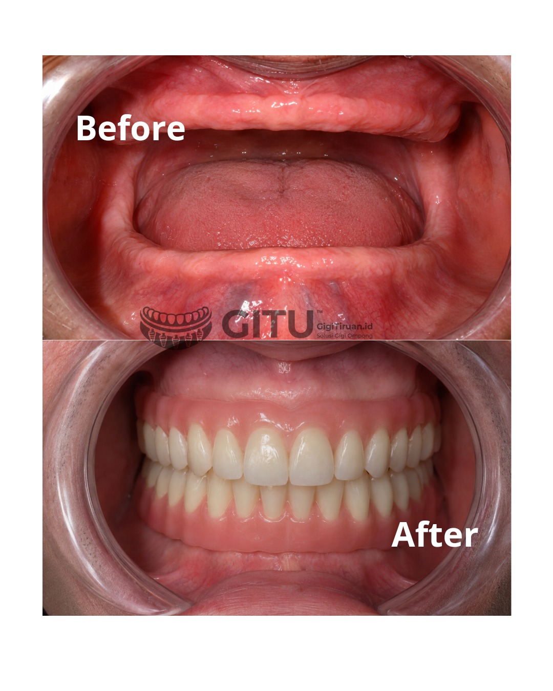 Hasil gigi tiruan penuh sebelum dan sesudah di Natura Dentica Jakarta Selatan